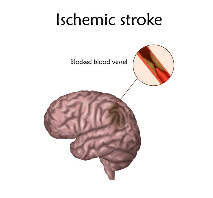 New Guidelines For Preventing Recurrent Stroke | Hospital Physician ...